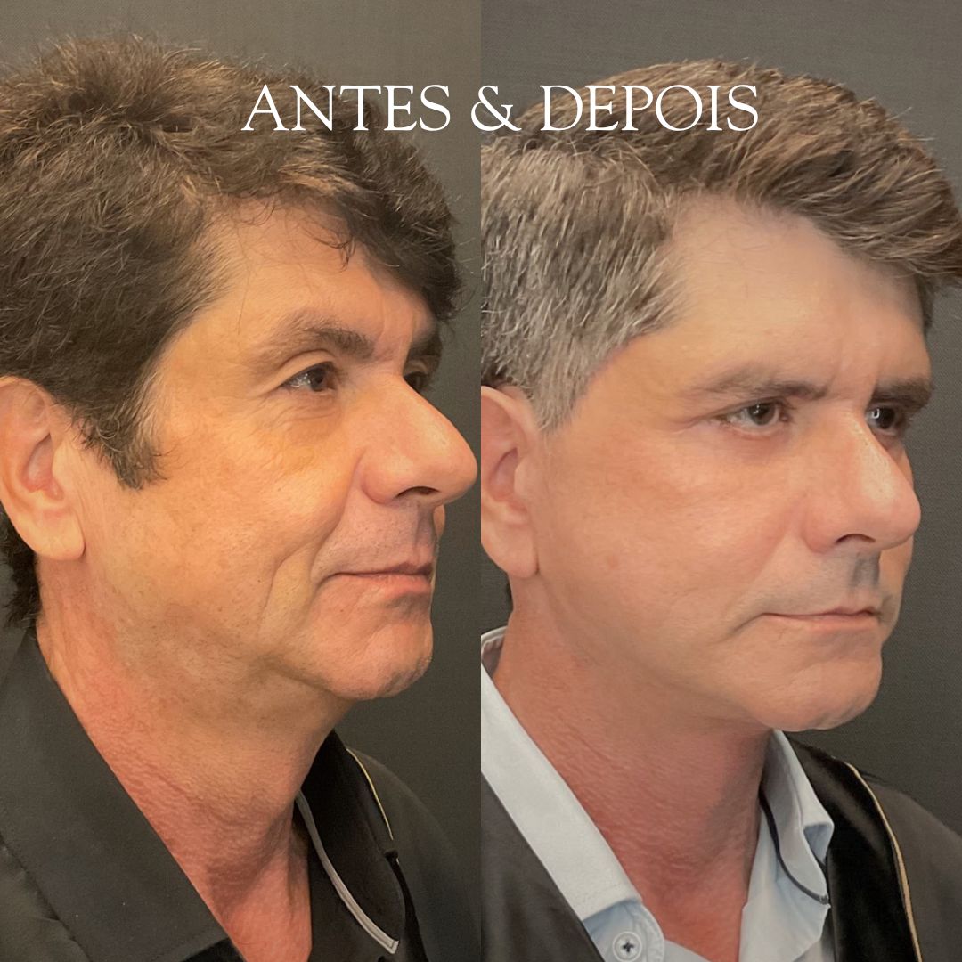Antes e depois - Resultado de procedimento