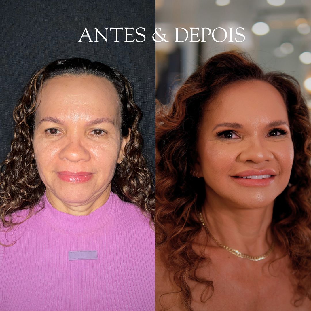 Antes e depois - Resultado de procedimento