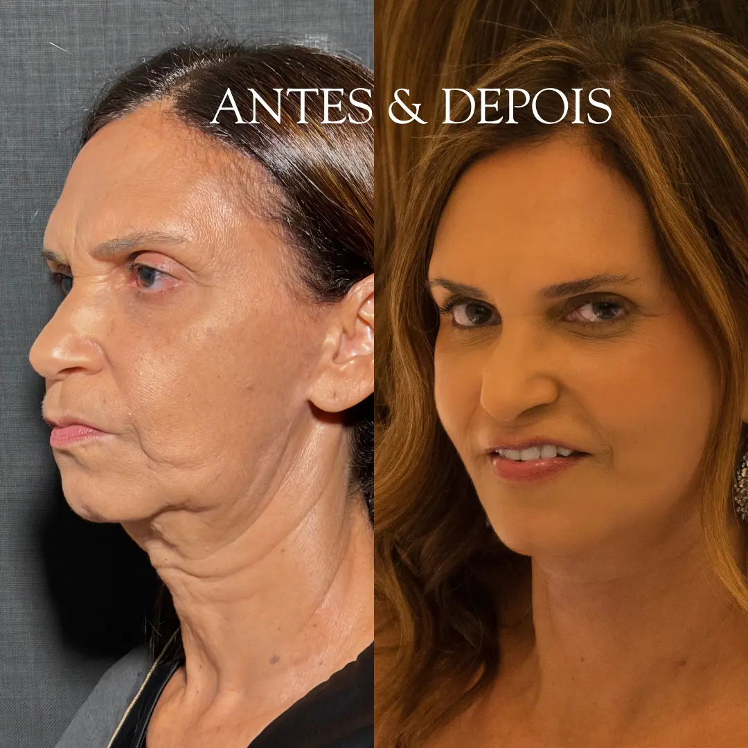 Antes e depois - Resultado de procedimento