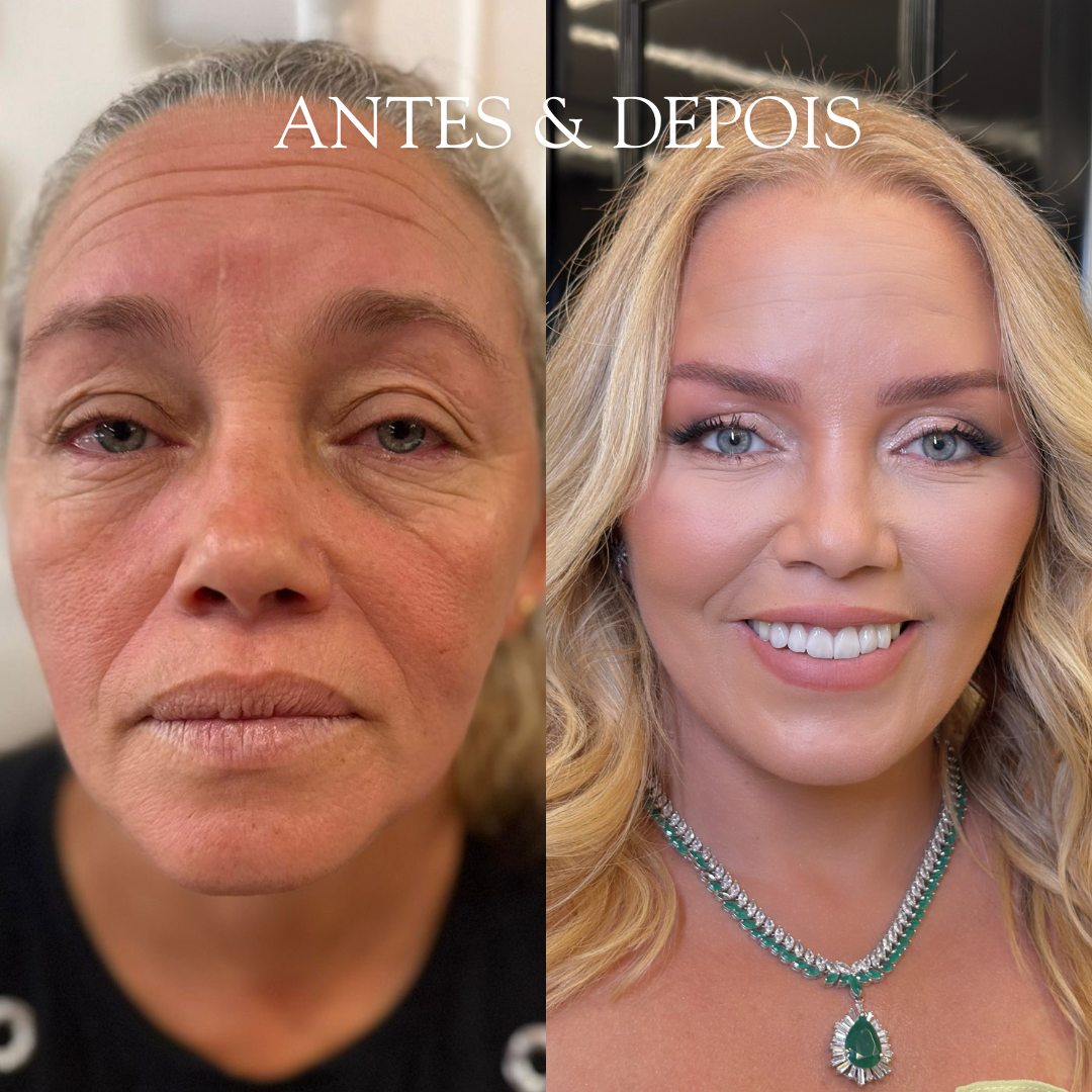 Antes e depois - Resultado de procedimento