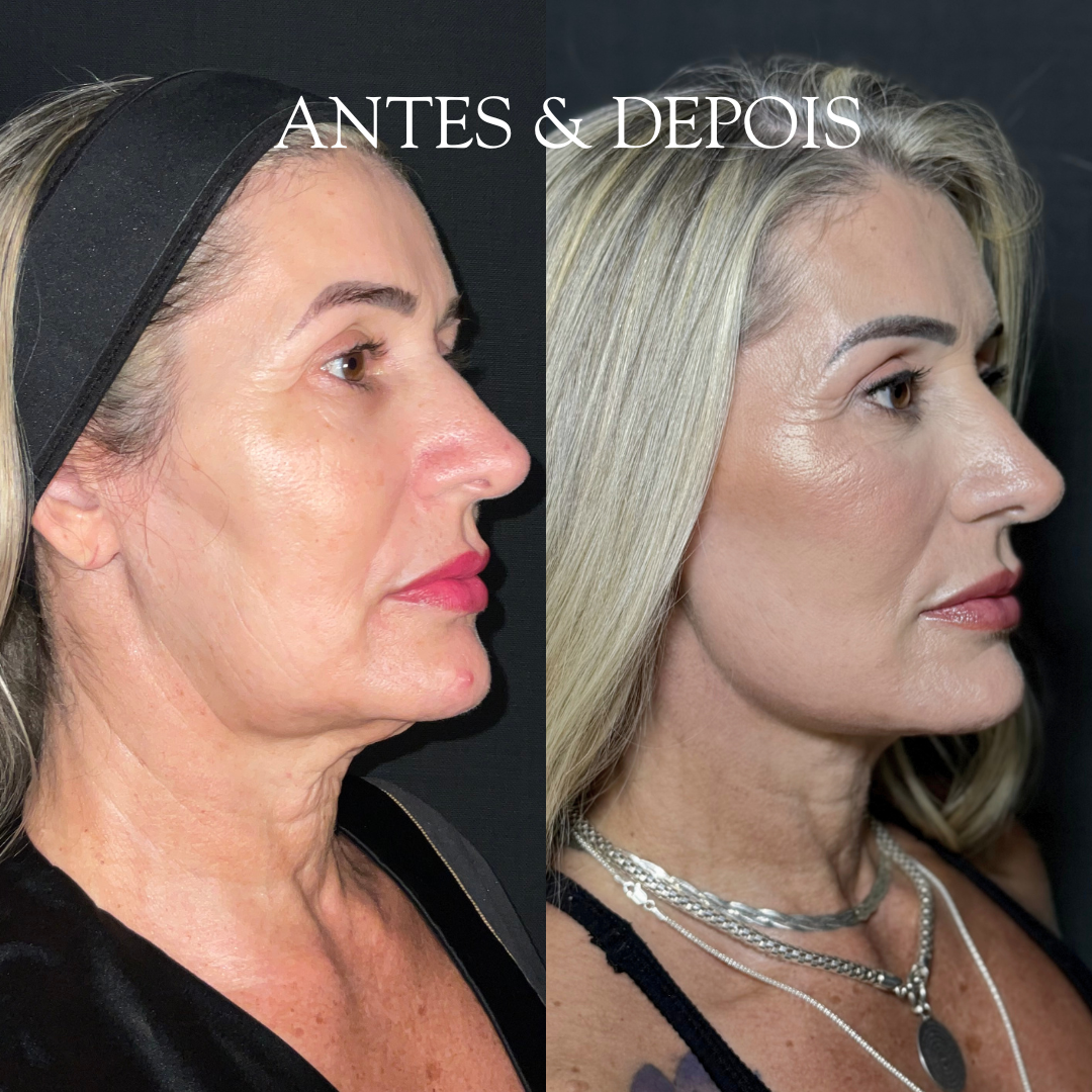 Antes e depois - Resultado de procedimento