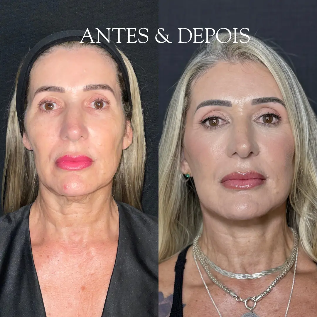 Antes e depois - Resultado de procedimento