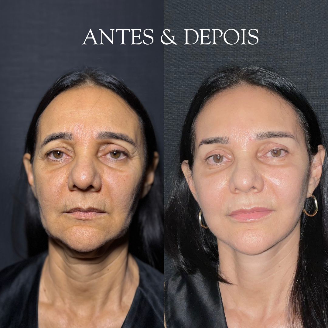Antes e depois - Resultado de procedimento