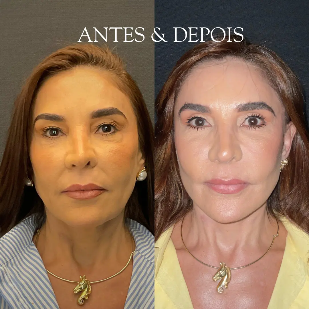 Antes e depois - Resultado de procedimento
