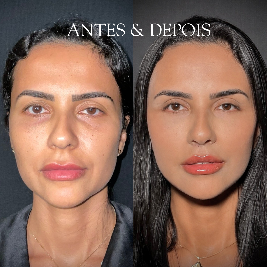 Antes e depois - Resultado de procedimento