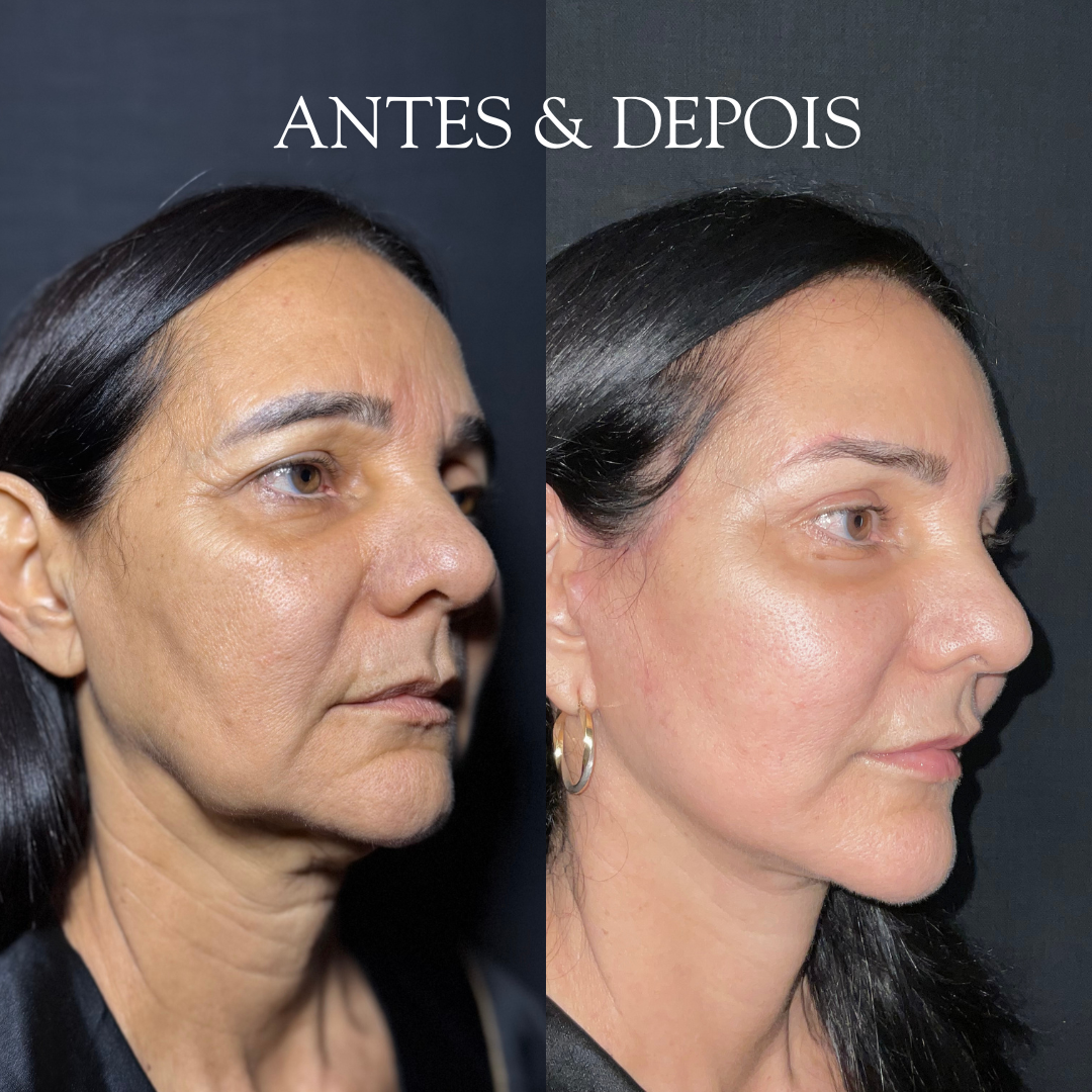 Antes e depois - Resultado de procedimento