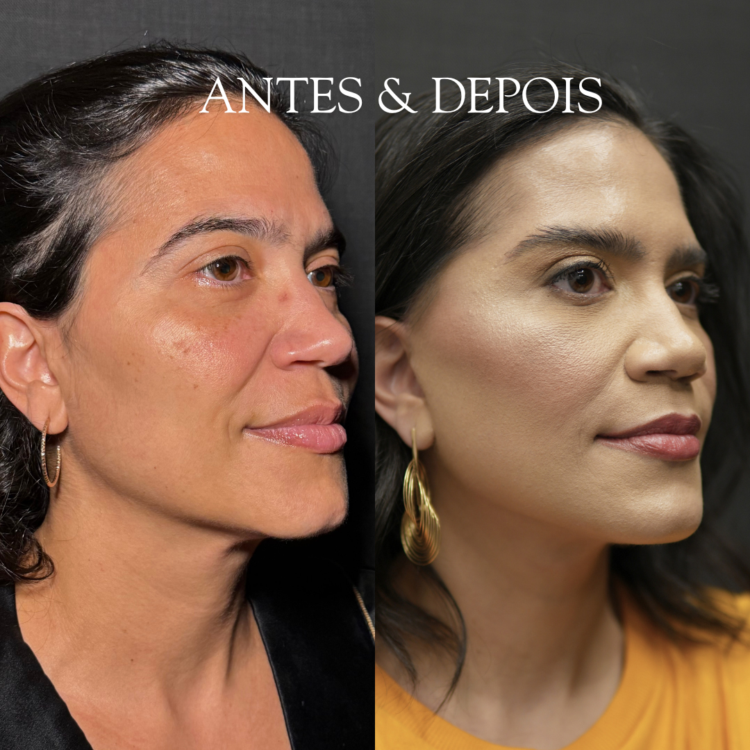 Antes e depois - Resultado de procedimento