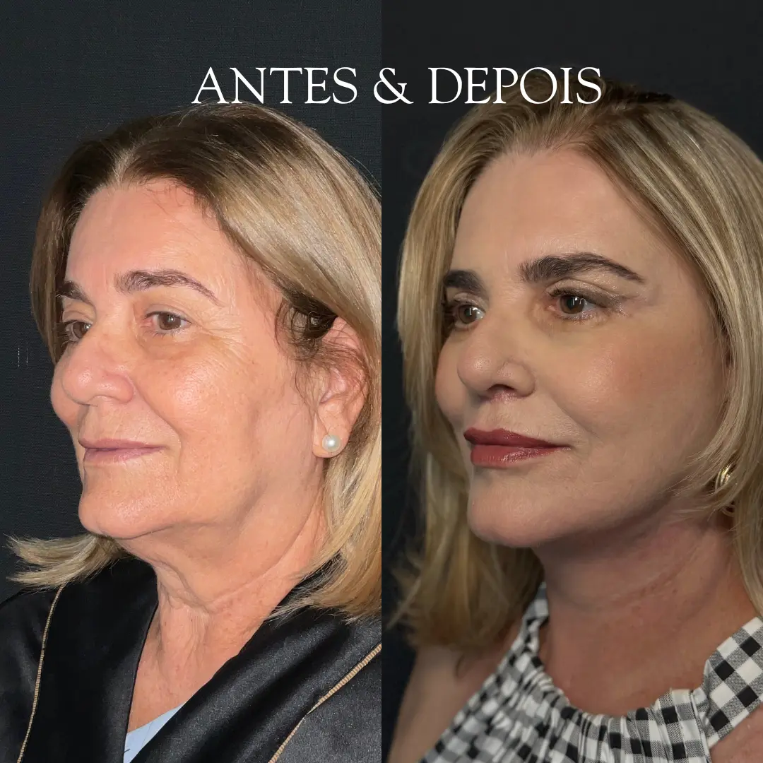 Antes e depois - Resultado de procedimento